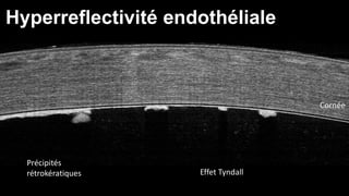 Cornée 
Hyperreflectivité endothéliale 
Précipités 
rétrokératiques Effet Tyndall 
 