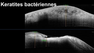 Keratites bactériennes 
 