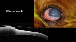 Kératomalacie 
 