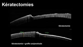 Kératectomies 
Kératectomie 
Kératectomie + greffe conjonctivale 
 