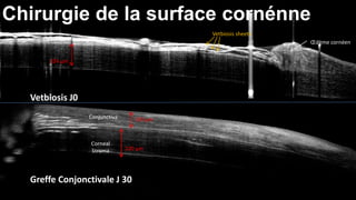 Chirurgie de la surface cornénne 
324 μm 
Vetbiosis J0 
Greffe Conjonctivale J 30 
Vetbiosis sheets 
OEdème cornéen 
Conjunctiva 
Corneal 
Stroma 
150 μm 
320 μm 
 