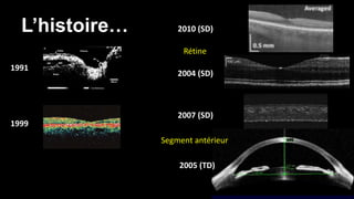 L’histoire… 
1991 
1999 
2010 (SD) 
Rétine 
2004 (SD) 
2007 (SD) 
Segment antérieur 
2005 (TD) 
 