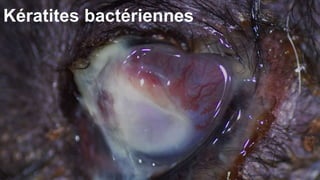 Kératites bactériennes 
 