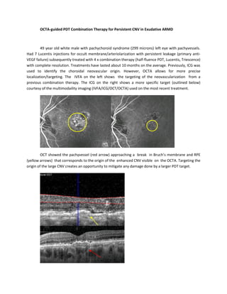 OCTA-guided PDT Combination Therapy for Persistent CNV in Exudative ARMD
49 year old white male with pachychoroid syndrome (299 microns) left eye with pachyvessels.
Had 7 Lucentis injections for occult membrane/arteriolarization with persistent leakage (primary anti-
VEGF failure) subsequently treated with 4 x combination therapy (half-fluence PDT, Lucentis, Triescence)
with complete resolution. Treatments have lasted about 10 months on the average. Previously, ICG was
used to identify the choroidal neovascular origin. However, OCTA allows for more precise
localization/targeting. The IVFA on the left shows the targeting of the neovascularization from a
previous combination therapy. The ICG on the right shows a more specific target (outlined below)
courtesy of the multimodaility imaging (IVFA/ICG/OCT/OCTA) used on the most recent treatment.
OCT showed the pachyvessel (red arrow) approaching a break in Bruch’s membrane and RPE
(yellow arrows) that corresponds to the origin of the enhanced CNV visible on the OCTA. Targeting the
origin of the large CNV creates an opportunity to mitigate any damage done by a larger PDT target.
 