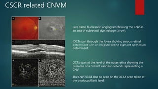 Cnv Macula Oct 5 Line OCT Angiography | PPTX