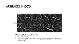 Oct Artefact Example OPTICAL COHERENCE TOMOGRAPHY ANGIOGRAPHY | PPTX