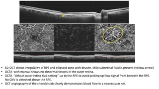 OPTICAL COHERENCE TOMOGRAPHY ANGIOGRAPHY | PPTX