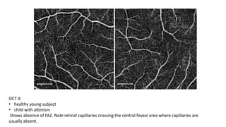 OPTICAL COHERENCE TOMOGRAPHY ANGIOGRAPHY | PPTX