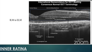 OCT AND OCT ANGIOGRAM.pptx. . | PPTX