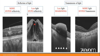 OCT AND OCT ANGIOGRAM.pptx. . | PPTX