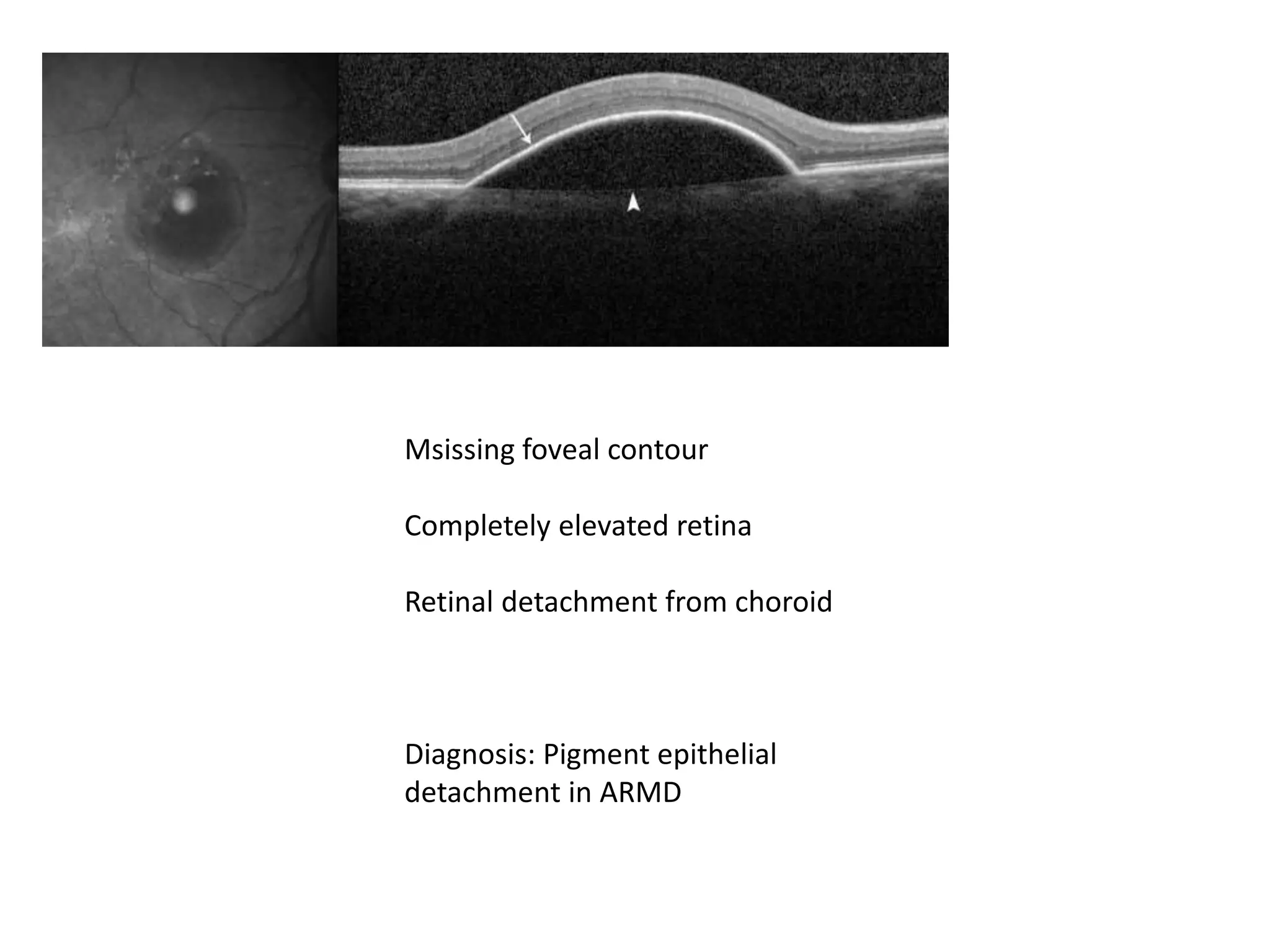 OCT AND VF cases pptx