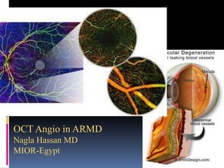 OCT Angio in ARMD
Nagla Hassan MD
MIOR-Egypt
 