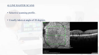 Macular Raster OCT MACULA INTERPRETATION. | PPTX