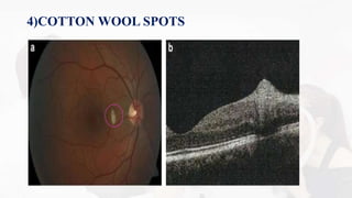 OCT MACULA INTERPRETATION. | PPTX