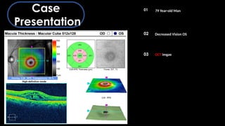Oct Artefact Example OCT Artifacts in Retinal Imaging and processing | PPTX