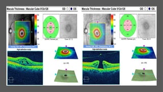 OCT Artifacts in Retinal Imaging and processing | PPTX
