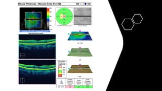 OCT Artifacts in Retinal Imaging and processing | PPTX
