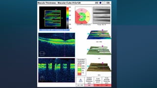 OCT Artifacts in Retinal Imaging and processing | PPTX