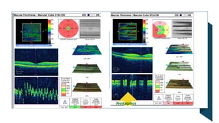 OCT Artifacts in Retinal Imaging and processing | PPTX