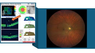OCT Artifacts in Retinal Imaging and processing | PPTX