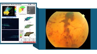 OCT Artifacts in Retinal Imaging and processing | PPTX