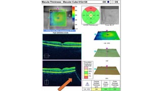 OCT Artifacts in Retinal Imaging and processing | PPTX