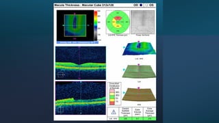 Oct Artefact Example OCT Artifacts in Retinal Imaging and processing | PPTX