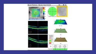 OCT Artifacts in Retinal Imaging and processing | PPTX