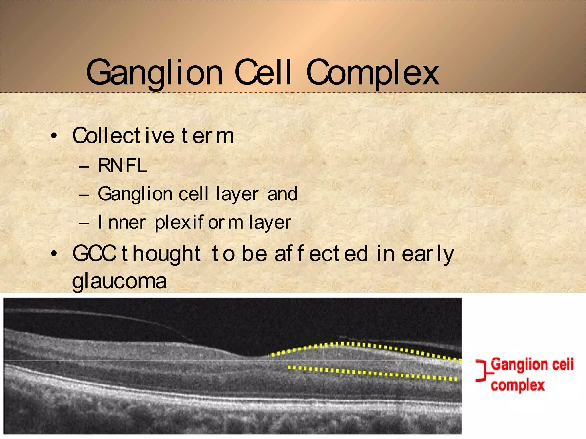 Ganglion Cell Complex
• Collect ive t er m
– RNFL
– Ganglion cell layer and
– I nner plexif orm layer
• GCC t hought t o be af f ect ed in ear ly
glaucoma
 