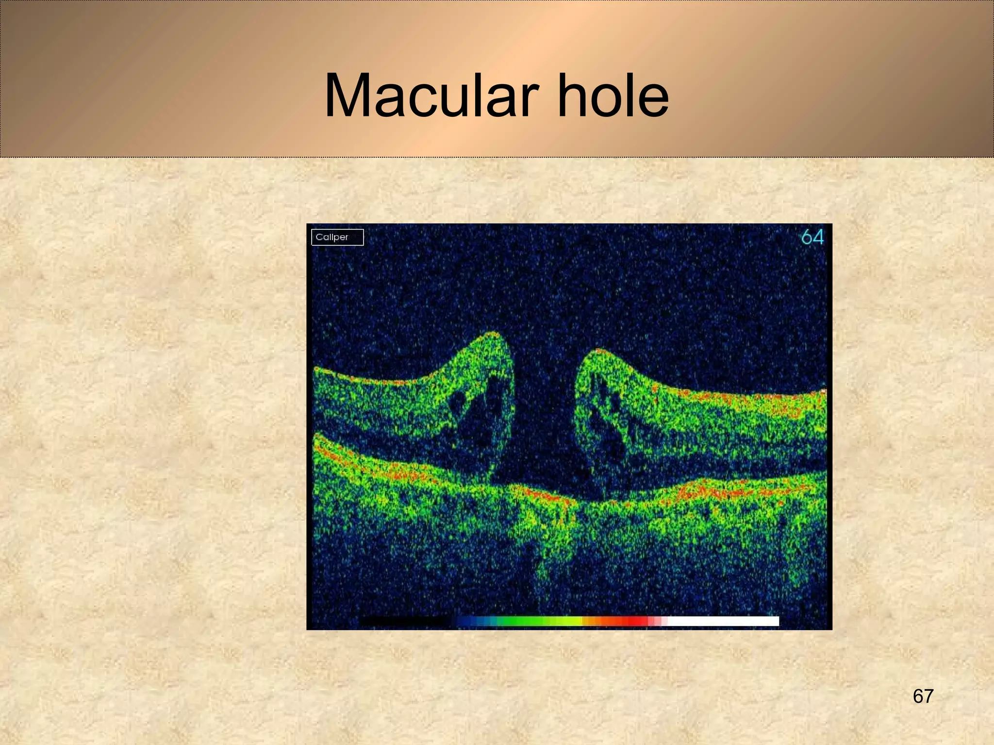 Macular hole
67
 