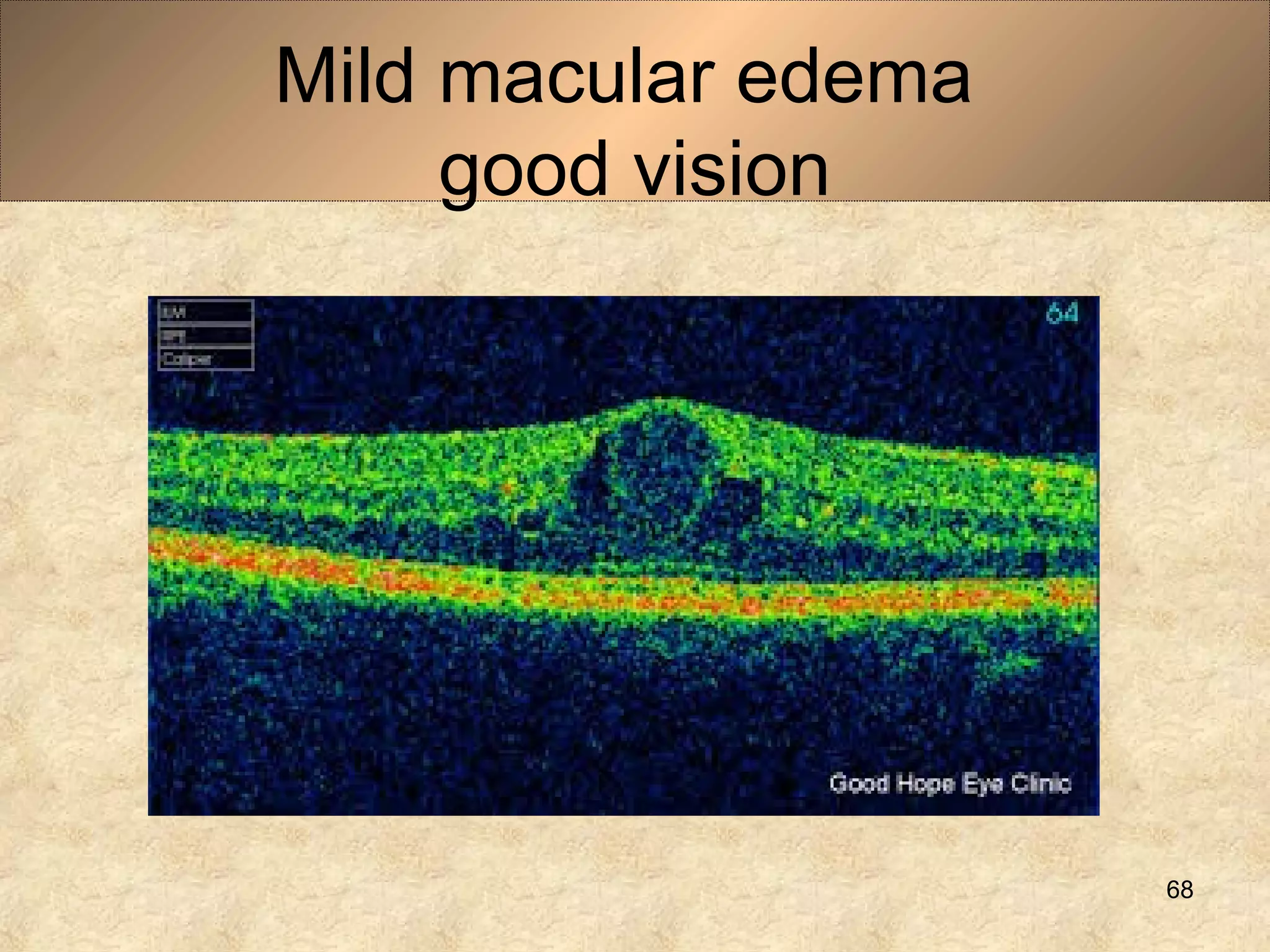 Mild macular edema
good vision
68
 