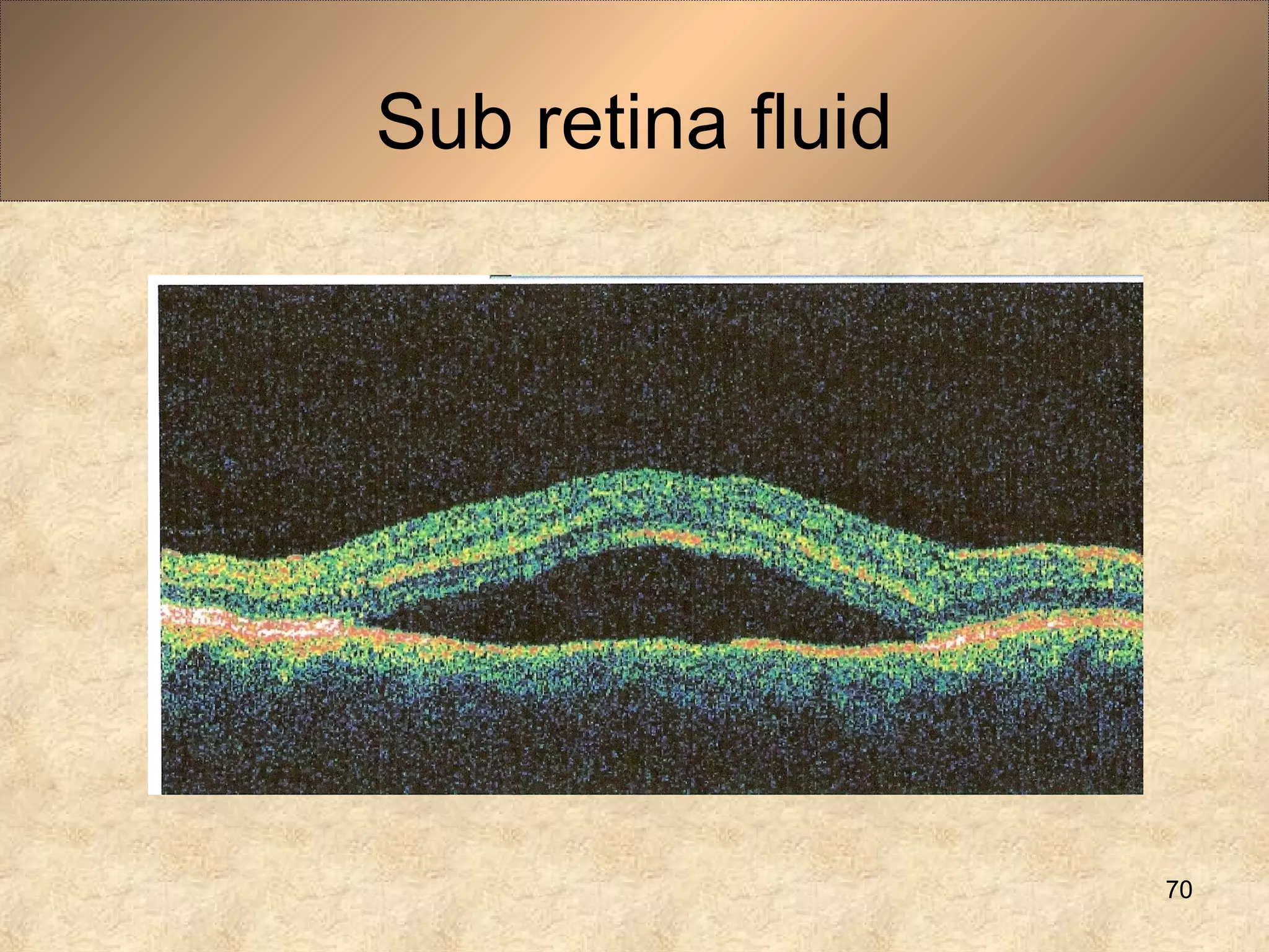 Sub retina fluid
70
 