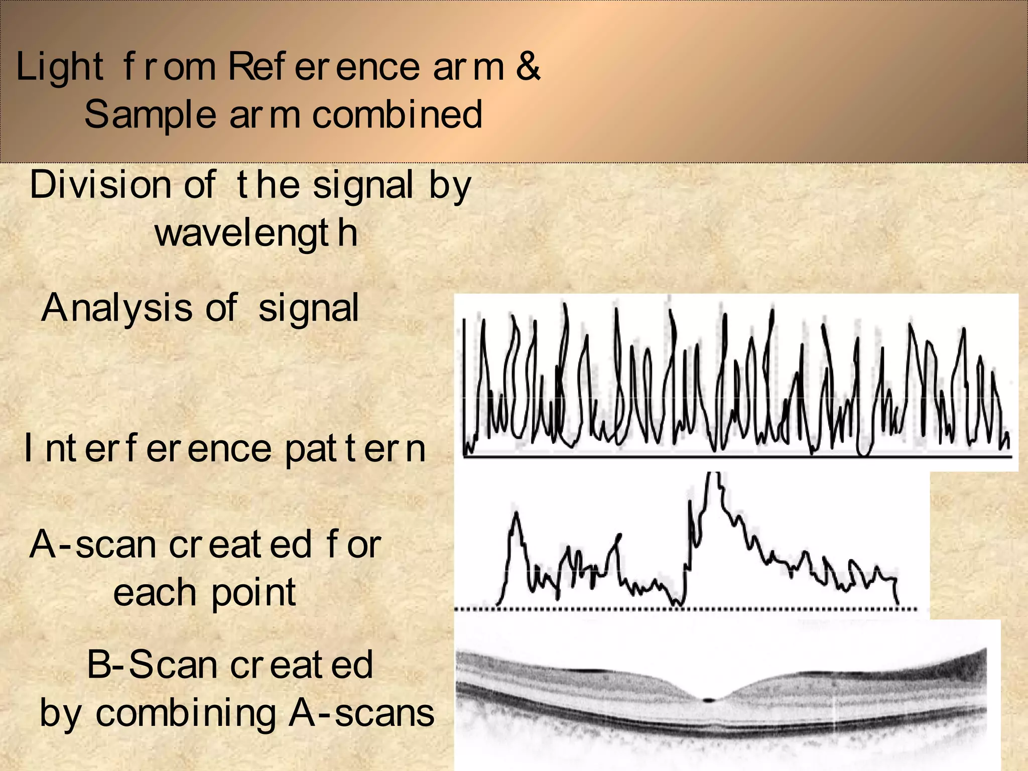 Light f r om Ref erence arm &
Sample arm combined
Division of t he signal by
wavelengt h
Analysis of signal
I nt er f er ence pat t ern
A-scan creat ed f or
each point
B-Scan creat ed
by combining A-scans
 