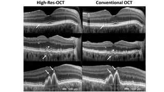 OCT biomarkers in macular disorders.pptx