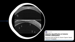 OCT biomarkers in uveitis.pptx