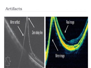 Oct Artefact Example Principle of Optical coherence tomography.pptx