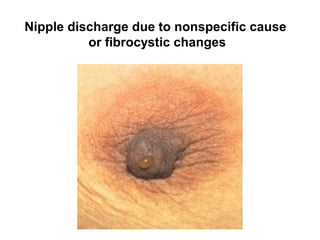 Nipple discharge due to nonspecific cause
or fibrocystic changes
 