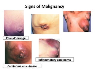 Signs of Malignancy
Carcinoma en cuirasse
Inflammatory carcinoma
Peau d’ orange
 