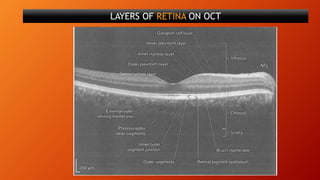 LAYERS OF RETINA ON OCT
 