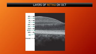LAYERS OF RETINA ON OCT
 