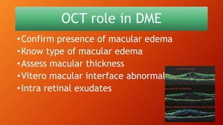 OCT role in DME
•Confirm presence of macular edema
•Know type of macular edema
•Assess macular thickness
•Vitero macular interface abnormalities
•Intra retinal exudates
 