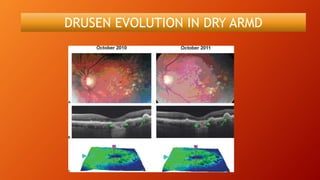 DRUSEN EVOLUTION IN DRY ARMD
 