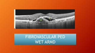 FIBROVASCULAR PED
WET ARMD
 