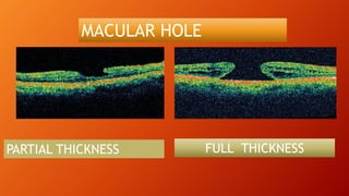 PARTIAL THICKNESS FULL THICKNESS
MACULAR HOLE
 