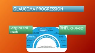 Ganglion cell
death
RNFL CHANGES
GLAUCOMA PROGRESSION
 