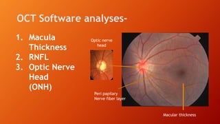 OCT Software analyses-
Peri papilary
Nerve fiber layer
Macular thickness
Optic nerve
head
1. Macula
Thickness
2. RNFL
3. Optic Nerve
Head
(ONH)
 