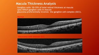 Ganglion cells- 30-35% of total retinal thickness at macula
upto 50%of ganglion cells in macula
glaucoma preferentially involves the ganglion cell complex (GCC).
Macula Thickness Analysis
Glaucoma with thinner GCC
Normal
 