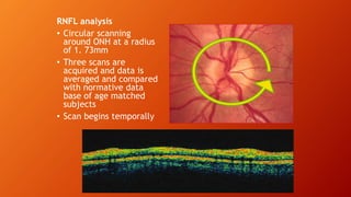 RNFL analysis
• Circular scanning
around ONH at a radius
of 1. 73mm
• Three scans are
acquired and data is
averaged and compared
with normative data
base of age matched
subjects
• Scan begins temporally
 