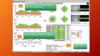 3
2
1 Zone -1-Pt.
I.D
Zone -2-TSNIT with age matched
normative data base
Zone-3-TSNIT overlap of two eyes
 