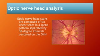 Optic nerve head analysis
Optic nerve head scans
are composed of six
linear scans in a spoke
pattern separated by
30-degree intervals
centered on the ONH
 